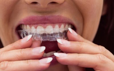 Apparecchio invisibile o tradizionale? Come scegliere l’ortodonzia giusta per te