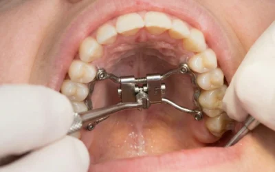 Terapia MSE (Espansione Scheletrica Mascellare): cos’è e come migliora la respirazione
